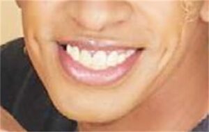 草間リチャード敬太の「歯」が話題！歯並び・セラミック治療の噂と真相を徹底解説