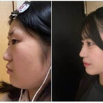 望月瑠愛に整形疑惑？ビフォーアフターと“垢抜けの秘訣”を徹底解説