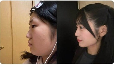 望月瑠愛に整形疑惑？ビフォーアフターと“垢抜けの秘訣”を徹底解説